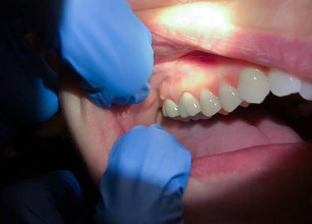 Best Emergency Treatment for Dental Infections or Abscesses in Scandia, MN
